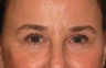 Eyelid Surgery / Fat Grafting