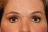 Fat Grafting/Eyelid Surgery