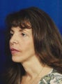 Facial Fat Grafting