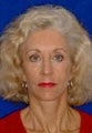 Facial Fat Grafting
