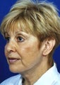 Fascial fat grafting and facelift
