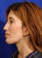 Fascial Fat Grafting