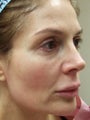 Lipo-augmentation of Face