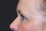 Eyelid Surgery / Fat Grafting