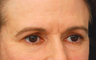 Eyelid Surgery / Fat Grafting