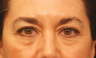 Eyelid Surgery / Fat Grafting