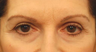 Eyelid Surgery / Fat Grafting