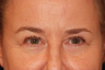 Eyelid Surgery / Fat Grafting