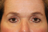 Fat Grafting/Eyelid Surgery