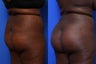 Fat Transfer