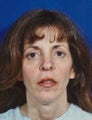 Facial Fat Grafting