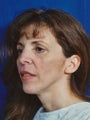 Facial Fat Grafting