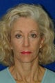 Facial Fat Grafting