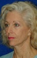 Facial Fat Grafting