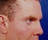 Facial Fat Grafting