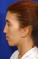Fascial Fat Grafting