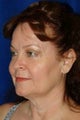Fascial fat grafting with facelift