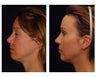 Structural Fat Grafting