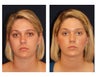 Fat Grafting / Chin Lipo