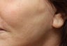 Fat Transfer to Cheeks