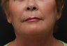 Fat transfer, facelift, neck lift