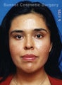 Facial Fat Grafting