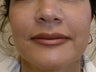 Fat transfer to nasolabial folds