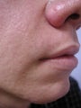 Fat transfer to nasolabial fold