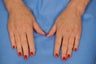 Fat Grafting to Hands