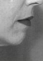 Facial Contouring