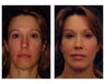 Structural Fat Grafting