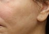 Fat Transfer to Cheeks