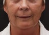 Fat transfer, facelift, neck lift