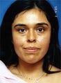 Facial Fat Grafting