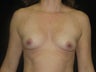 Natural Fill Breast Augmentation