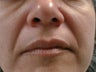 Fat transfer to nasolabial folds
