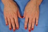 Fat Grafting to Hands