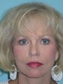 Full Facial Rejuvenation
