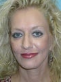 Full Facial Rejuvenation