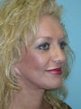 Full Facial Rejuvenation