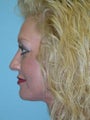 Full Facial Rejuvenation