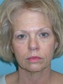 Full Facial Rejuvenation