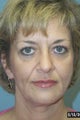 Full Facial Rejuvenation