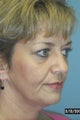 Full Facial Rejuvenation