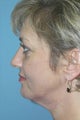 Full Facial Rejuvenation