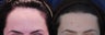 Forehead Reduction Surgery or Hairline Lowering Surgery