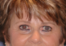 Pretrichial forehead lift and upper blepharoplasty