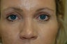 Forehead Lift