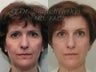 Endoscopic Forehead Lift