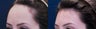 Forehead Reduction Surgery or Hairline Lowering Surgery